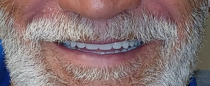 after_1 Close-up of a senior patient with white teeth, natural-looking dentures bright smile