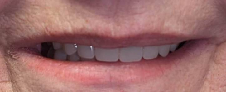after_2 Close-up of a patient's smile after dental treatment showing a complete set of aligned, white teeth