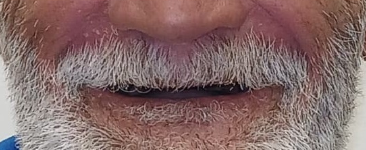 before_1 Close-up of a senior male patient with missing upper and lower teeth before dental treatment
