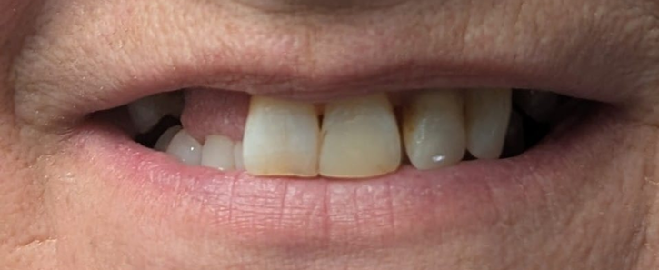 before_2 Close-up of a patient's mouth showing missing teeth and misalignment before dental restoration